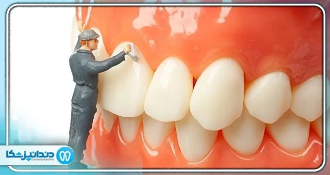 آیا جرم گیری به دندان ها آسیب می رساند