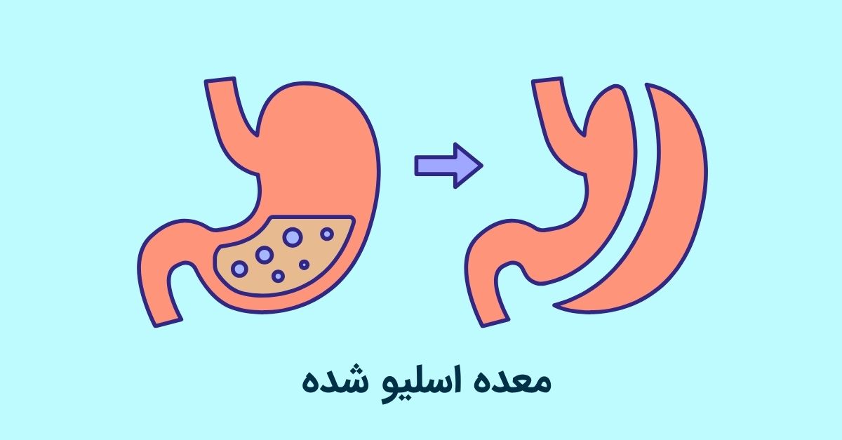 معده اسلیو شده