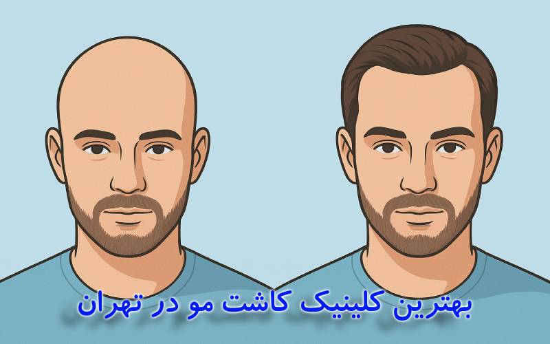 بهترین کلینیک کاشت مو در تهران