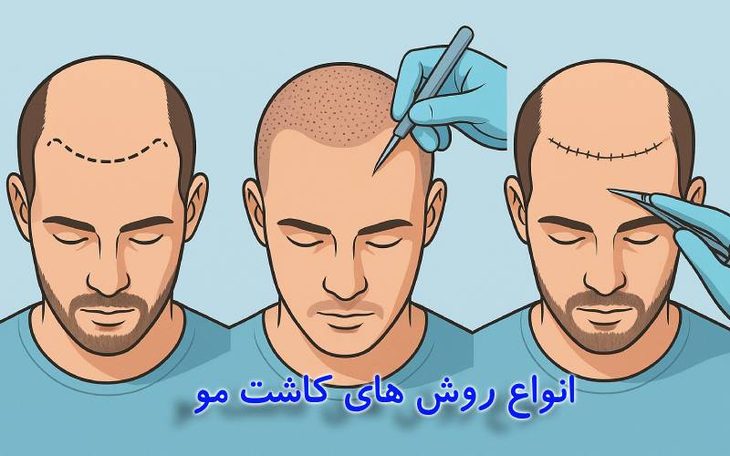 انواع روش های کاشت مو
