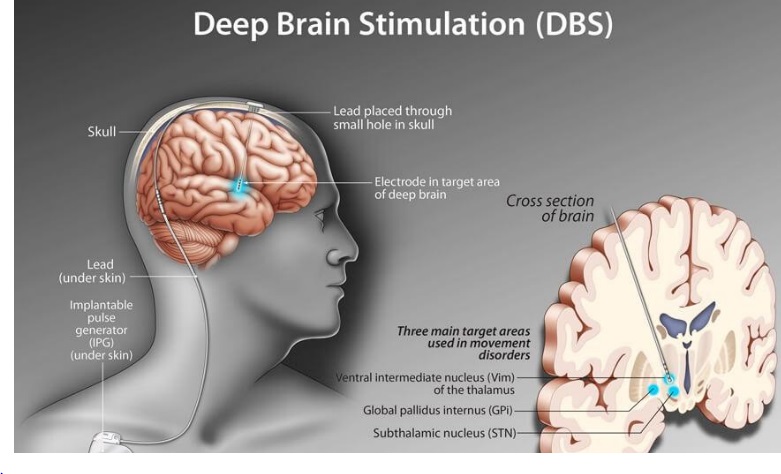 تحریک عمیق مغزی (DBS)