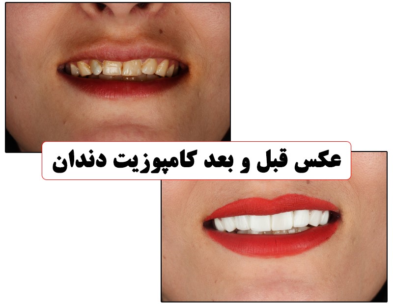 عکس کامپوزیت دندان قبل و بعد