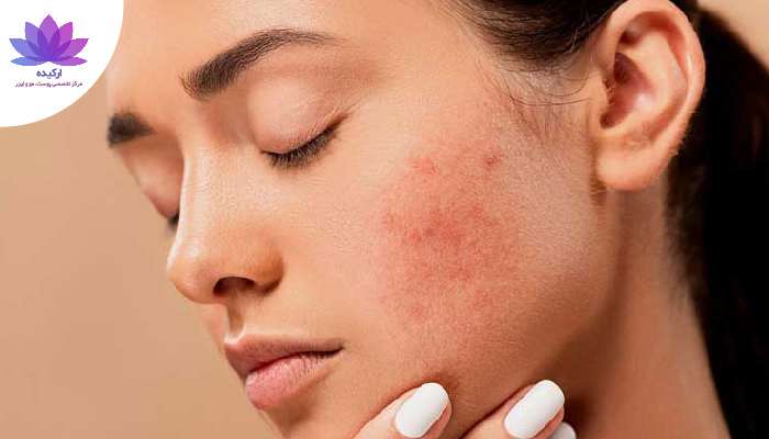 نقش استرس و اضطراب در پیری پوست