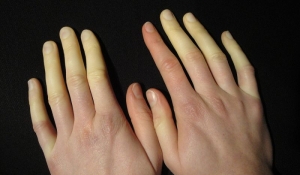 سندروم رینود (Raynaud's Syndrome) چیست ؟ انواع، علائم،&nbsp; علل و درمان آن